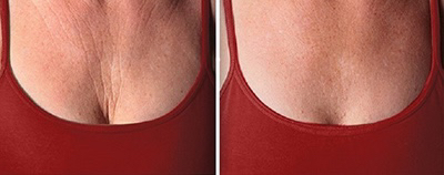 SMAS - лифтинг декольте/шея