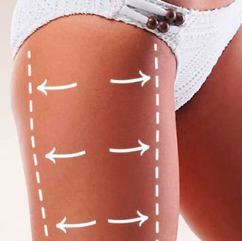 SMAS-лифтинг голифе