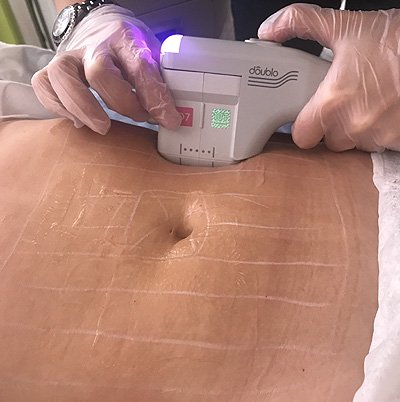 SMAS-лифтинг живот