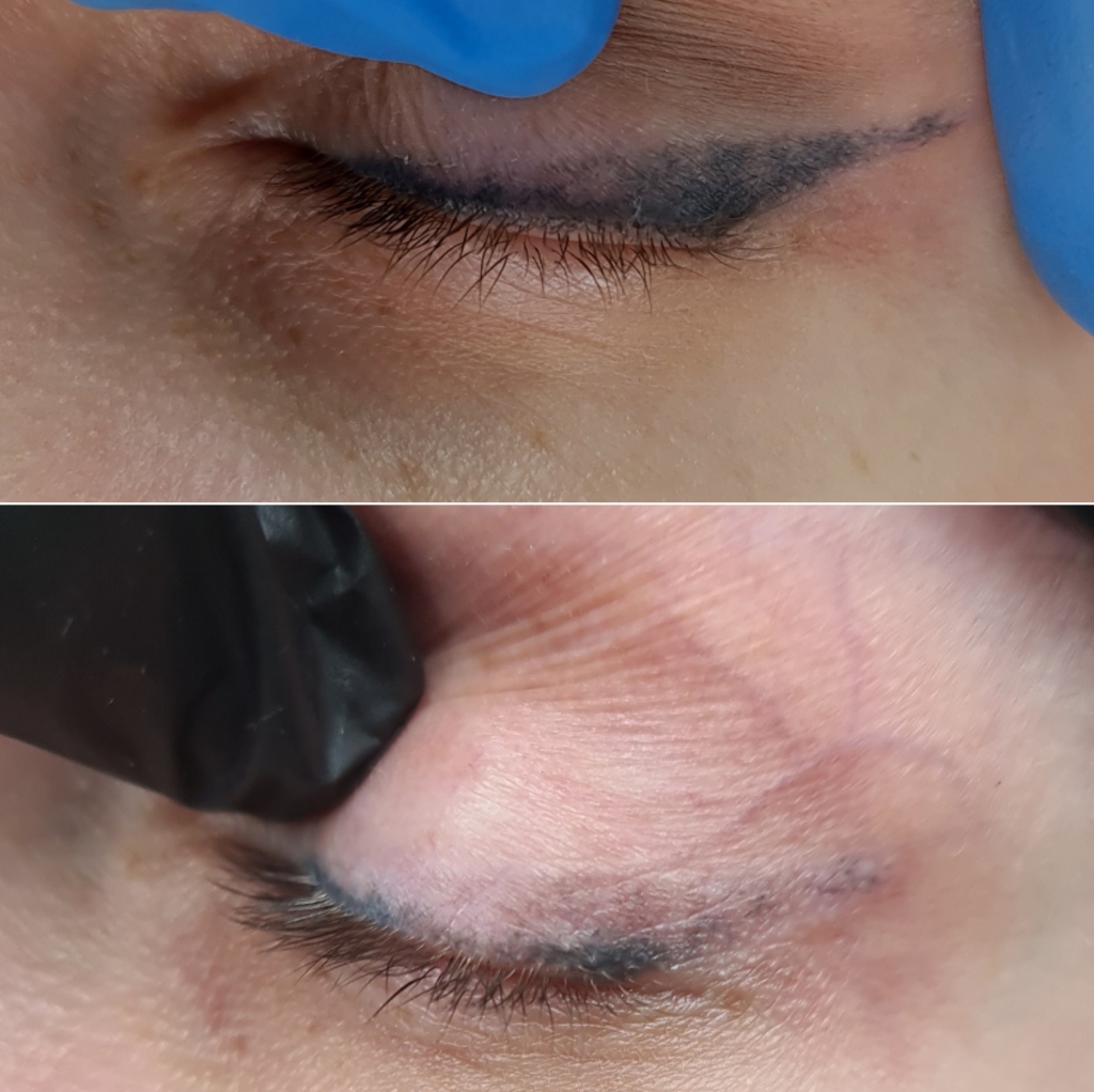 Удаление ПМ с век