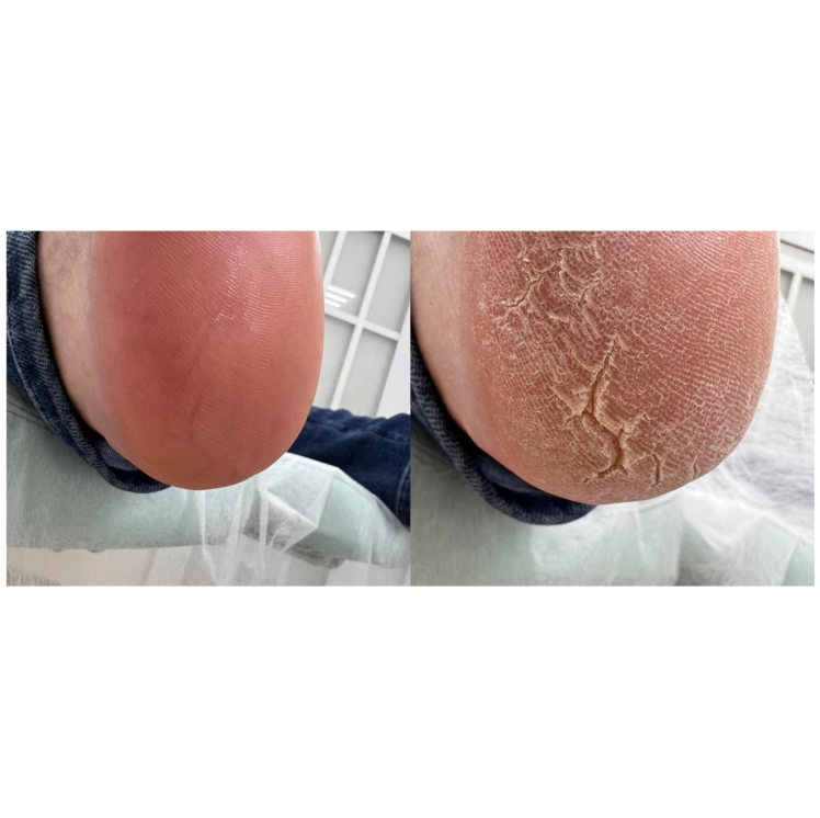 Подологический Педикюр .Педикюр повышенной сложности, наличие грибковых ,утолщенных ногтей,трещины, мозоли)