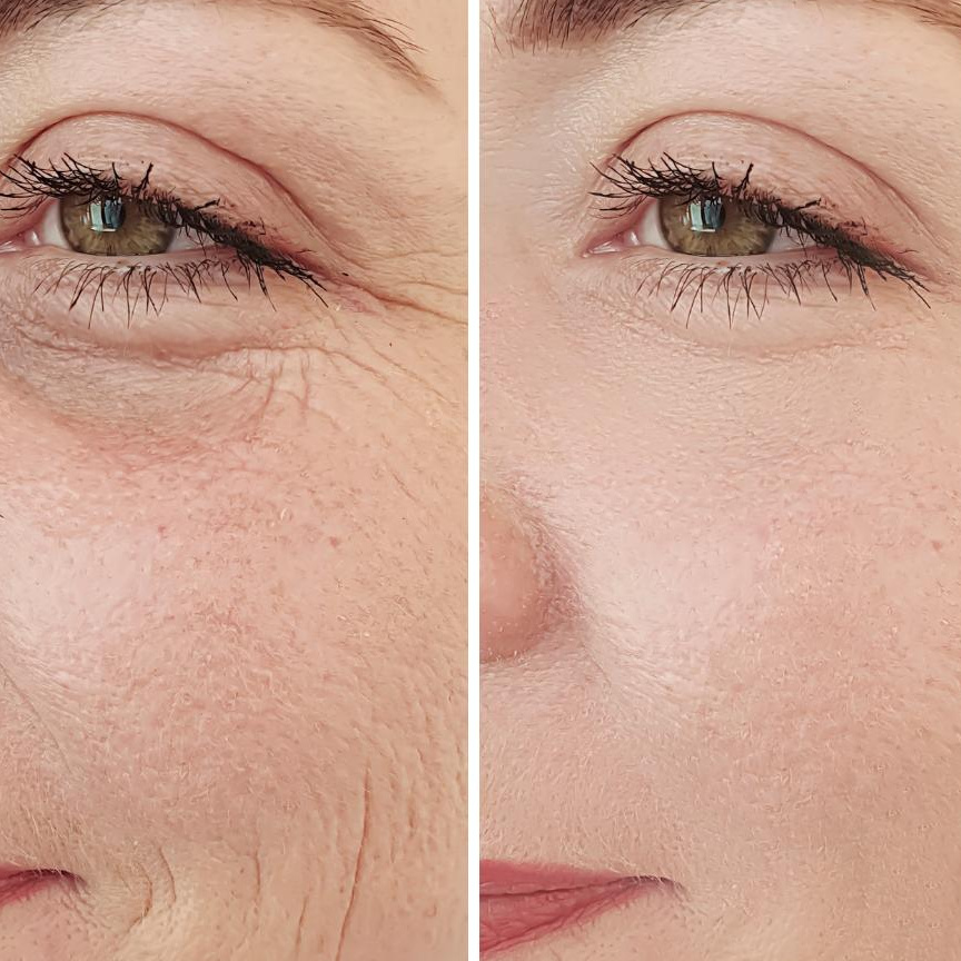 PRX-T33 Regenerative Peel