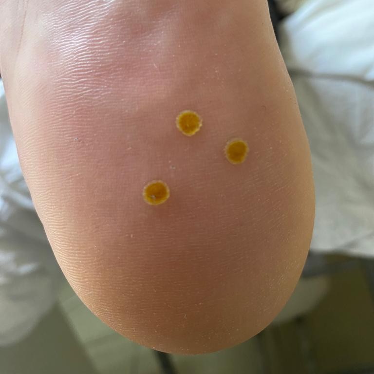 Работа с бородавками