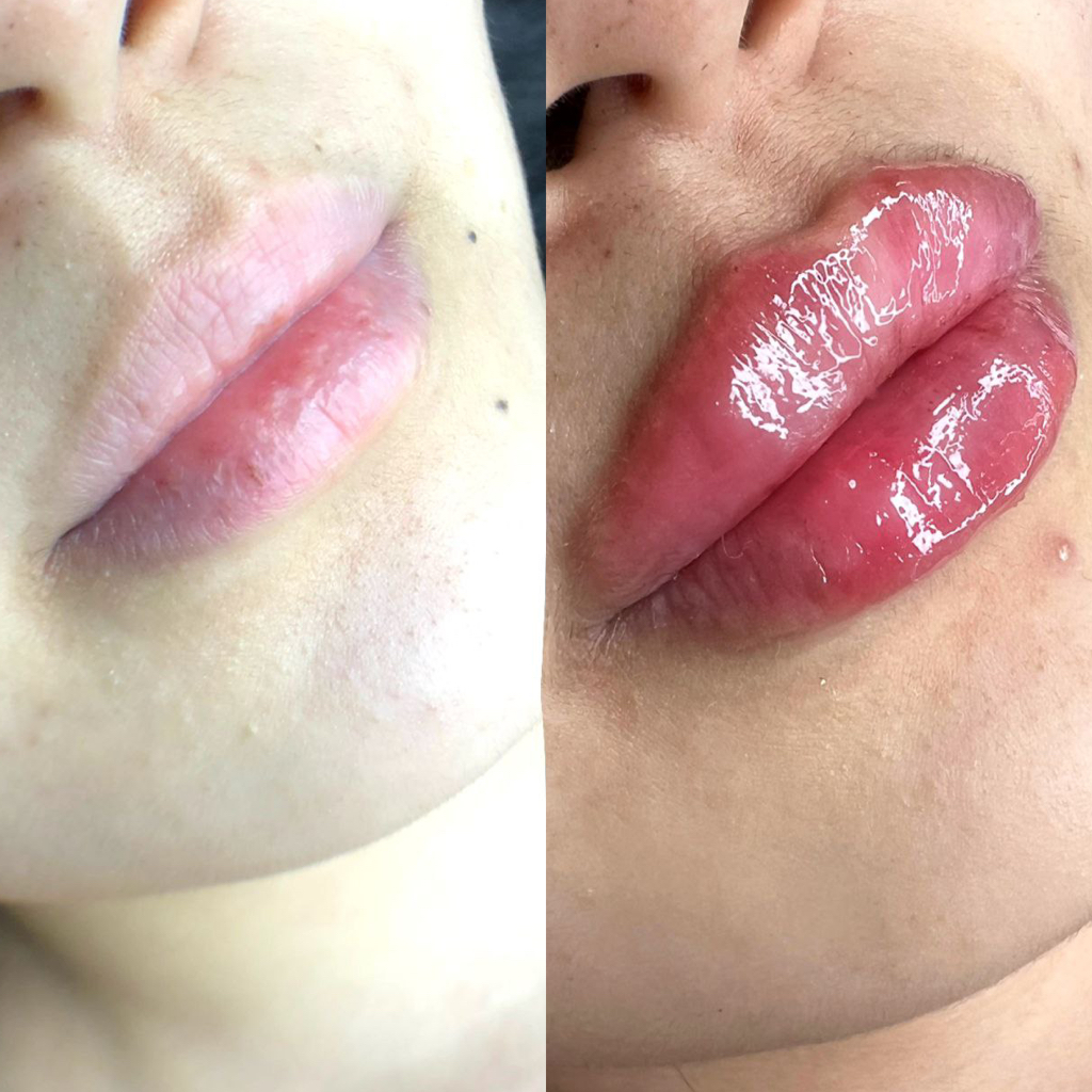 Контурная пластика губ