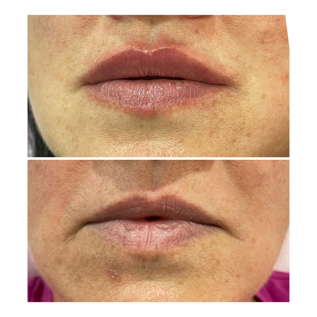 Аугментация губ