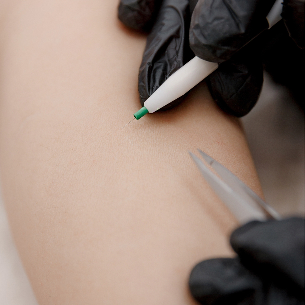 Пробная процедура электроэпиляции оплата 400 руб за иглу