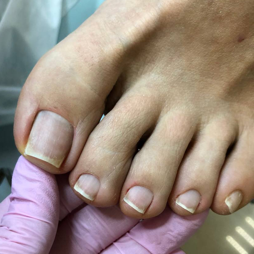 Пальчики без покрытия
(Здоровые ногти , без видимых изменений )