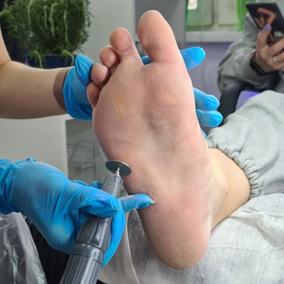 SMART Обработка стоп при наличии трещин, мозолей, натоптышей