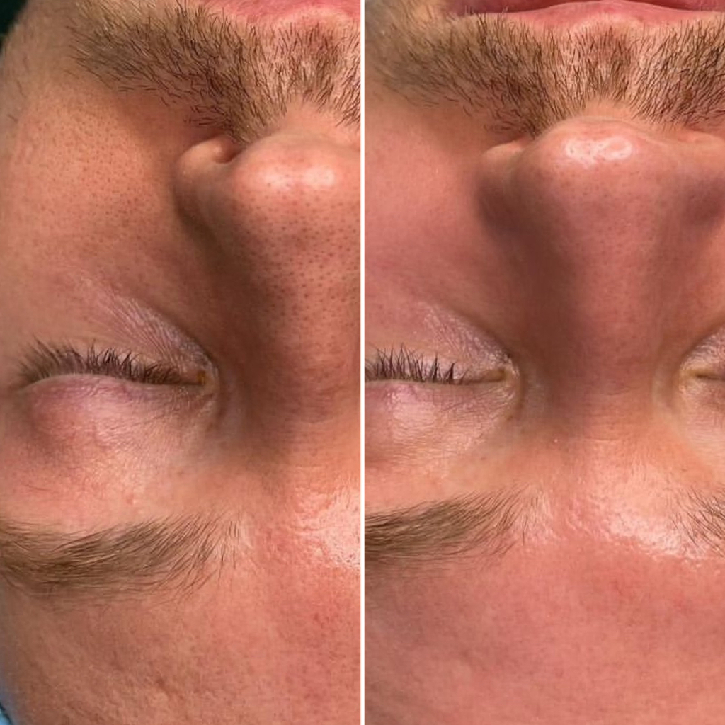 МУЖСКАЯ чистка лица