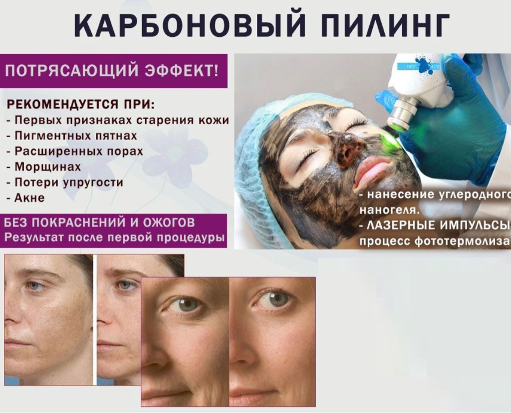 Карбоновый пилинг