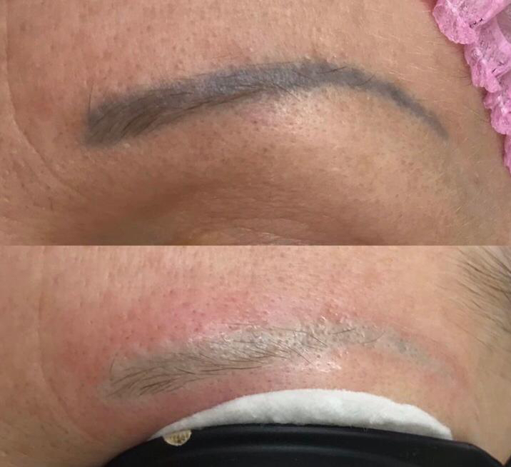 Лазерное удаление татуажа и тату