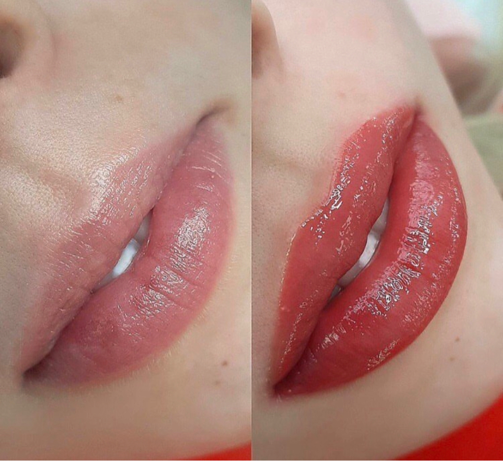 Коррекция ПМ через месяц губы