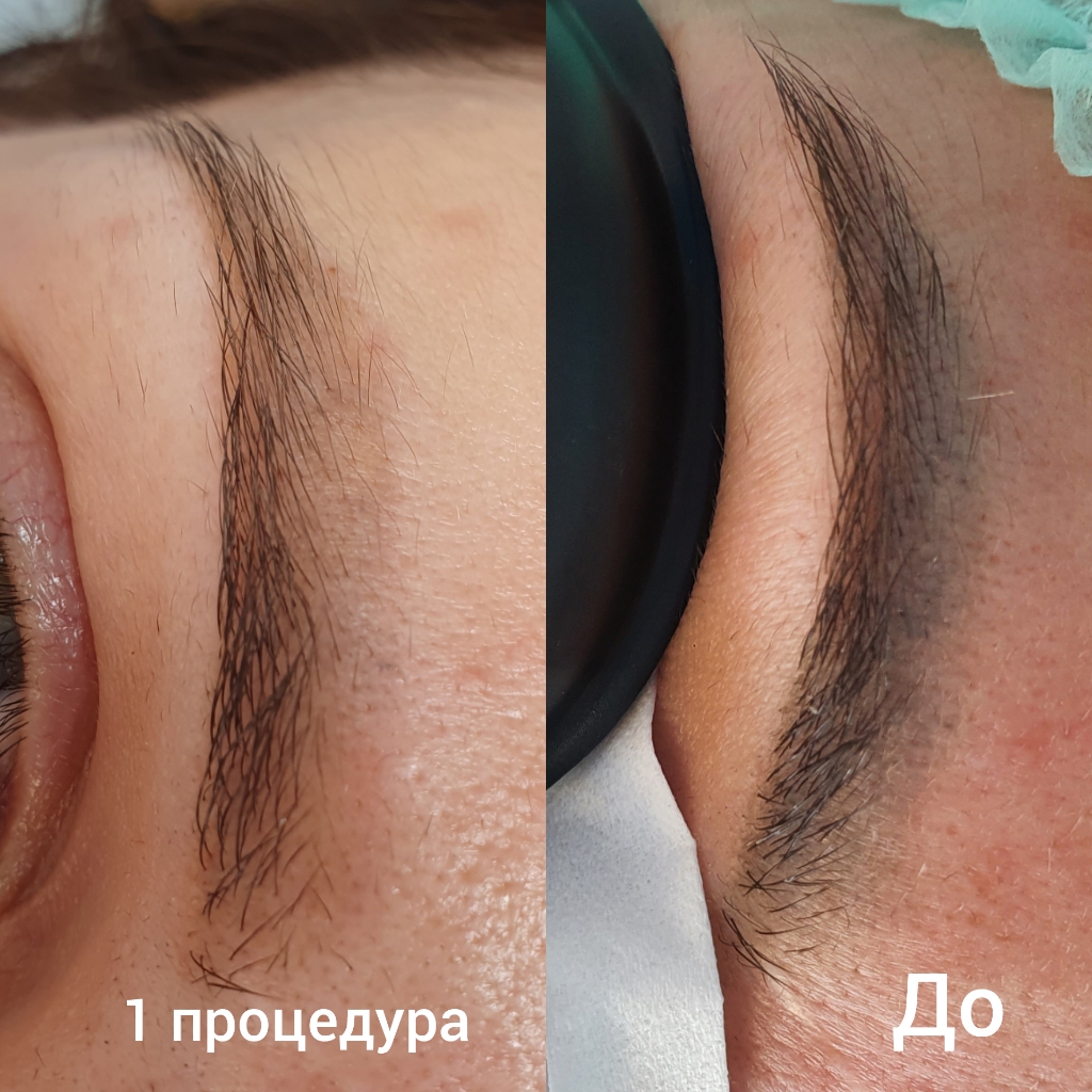Удаление татуажа/тату