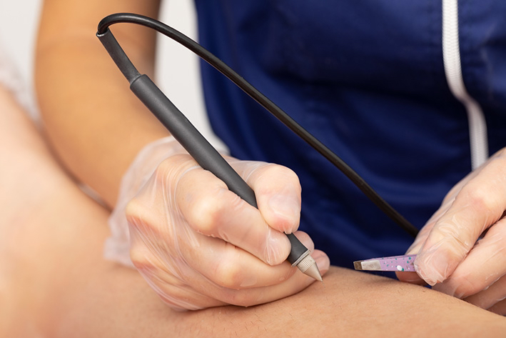 Электроэпиляция