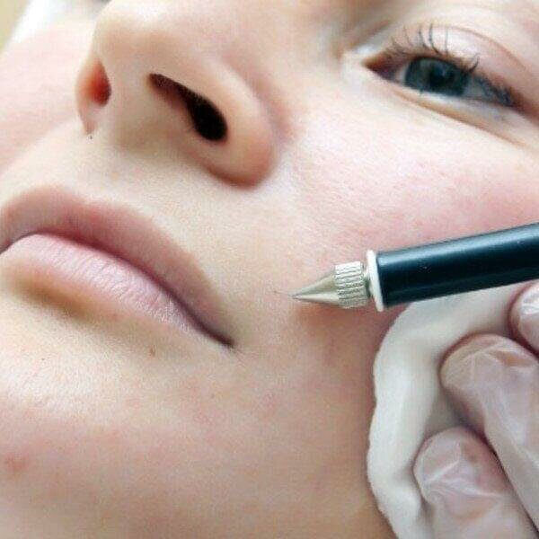 Электроэпиляция