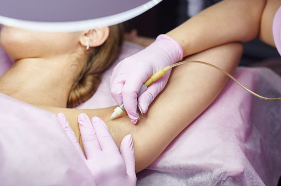 Электроэпиляция