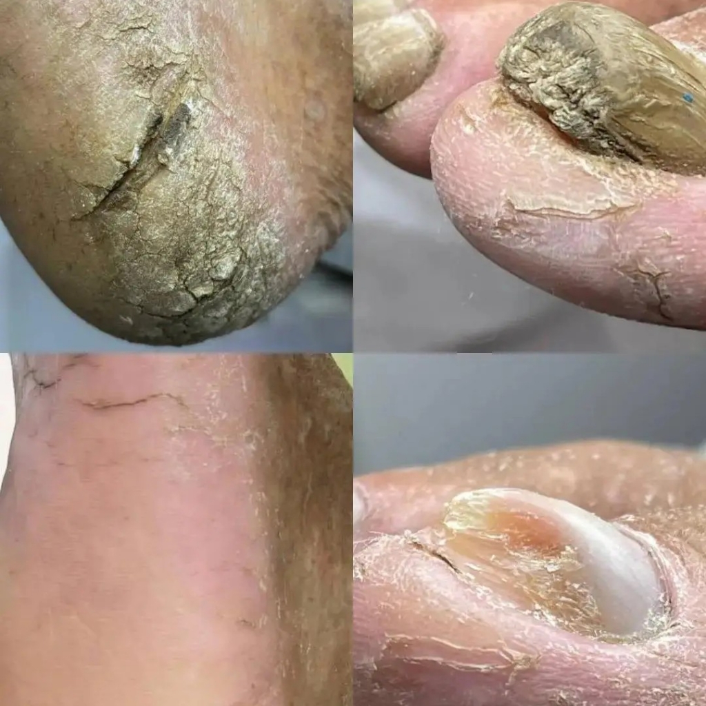 Подологический педикюр