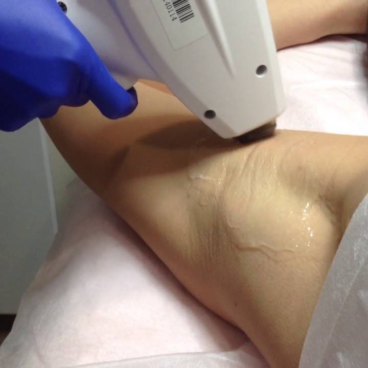 Лазерная эпиляция подмышки