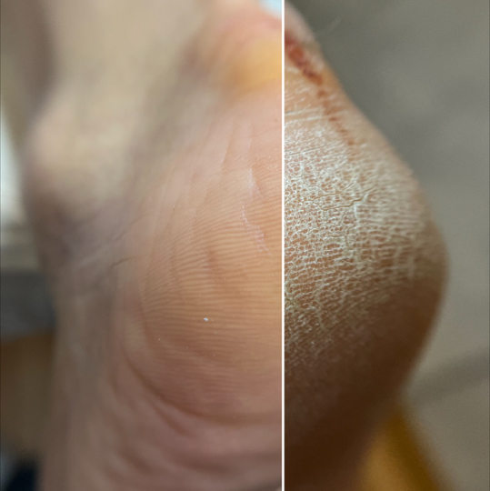 Обработка стопы