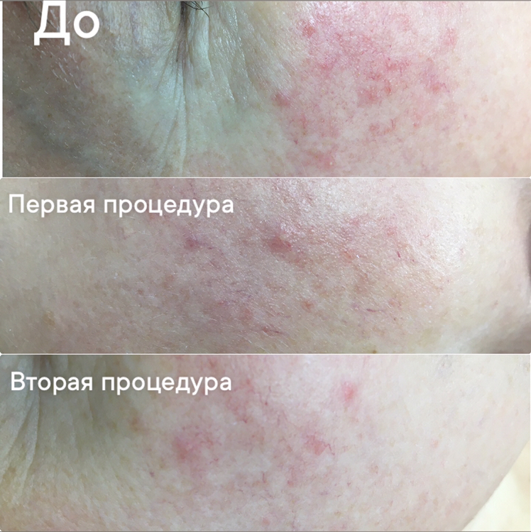 Программа: Анти Купероз