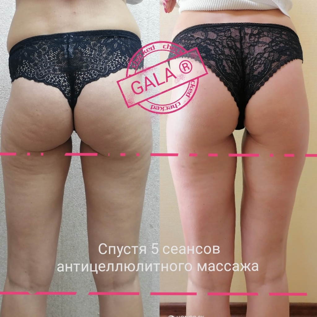 Массаж антицеллюлитный