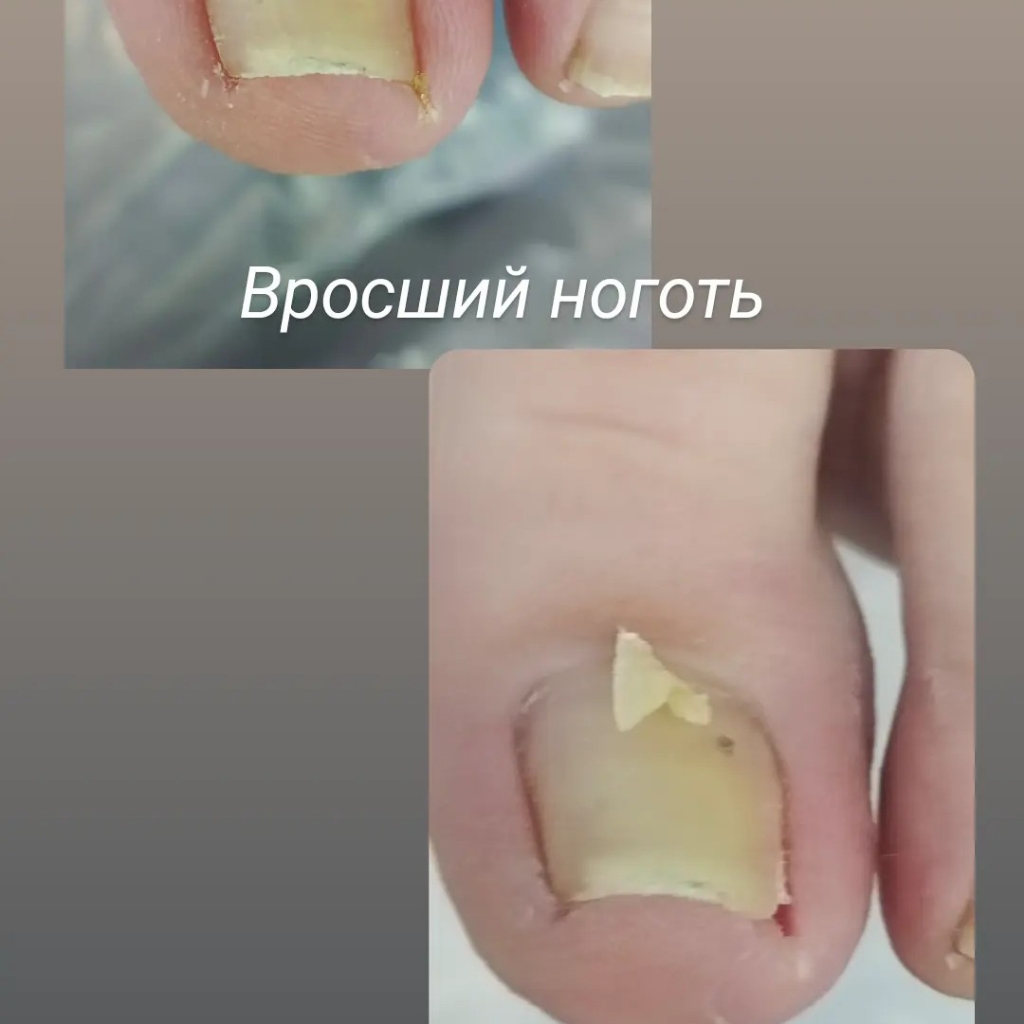 Работа с вросшим ногтем 1 степени (отек бокового валика, покраснение)