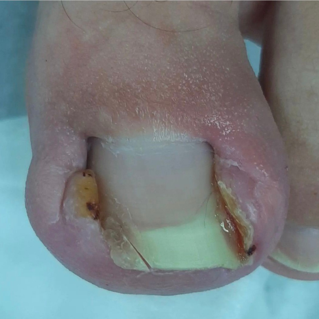 Работа с вросшим ногтем 3 степени (отек бокового валика, покраснение, гное-течение, грануляция)