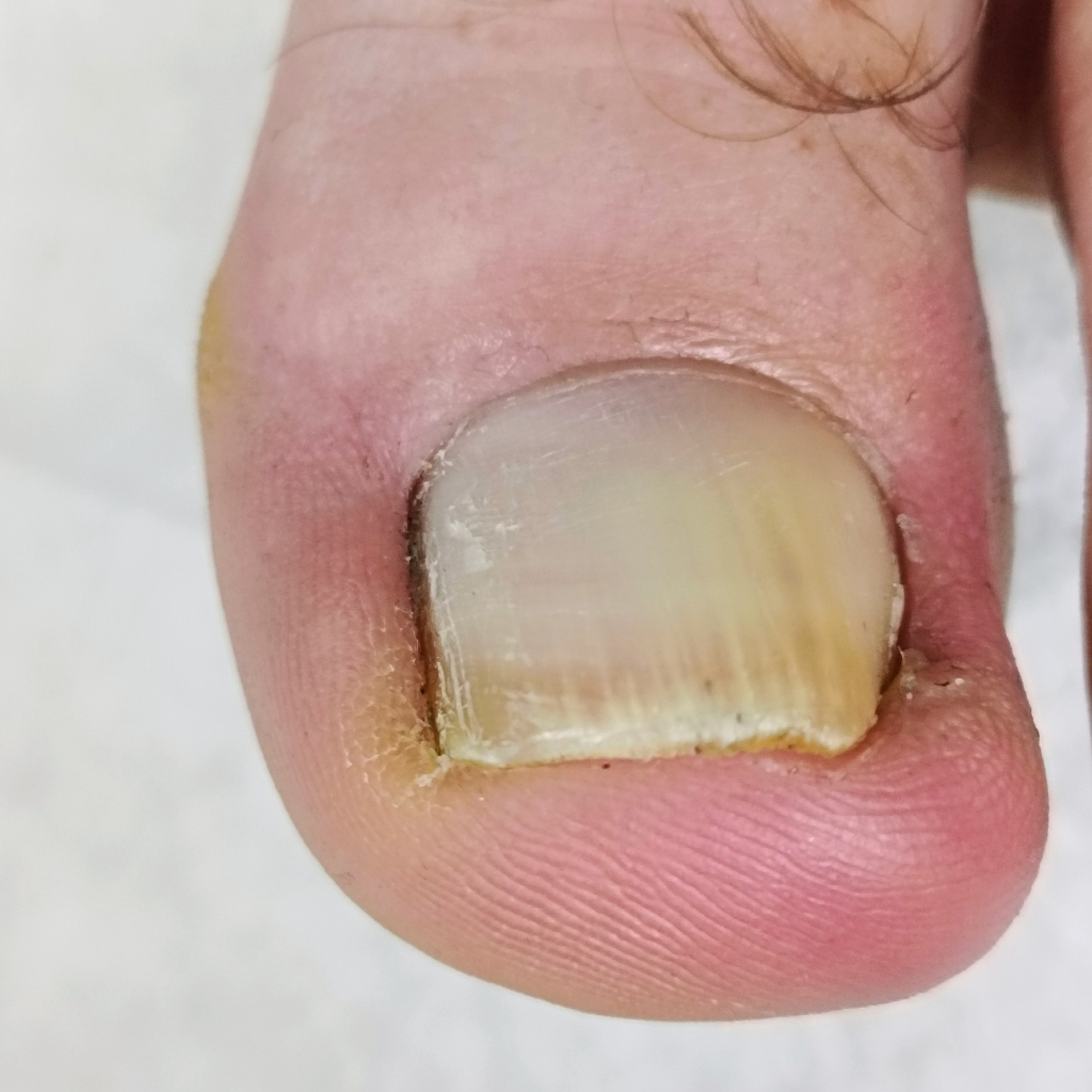 Работа с  вросшим ногтем 2 степени (отек бокового валика, покраснение, гное-течение)