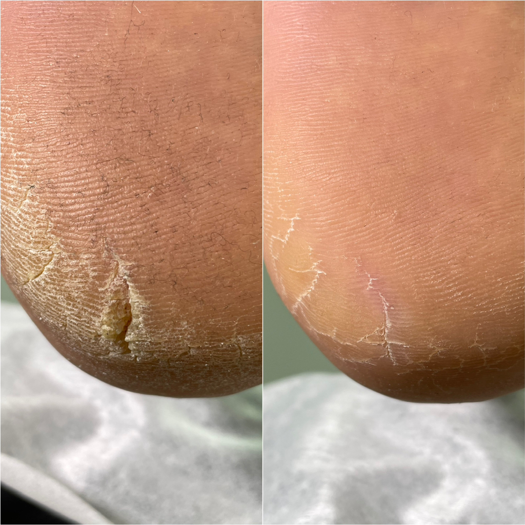 Педикюр подологический ( трещины, кератоз, микоз)