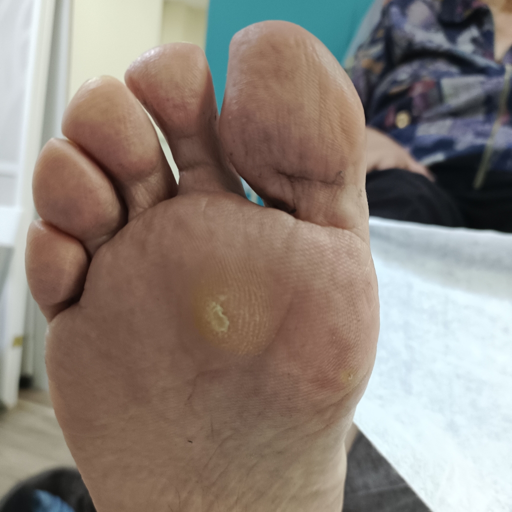 Обработка мозоли (отдельная процедура)