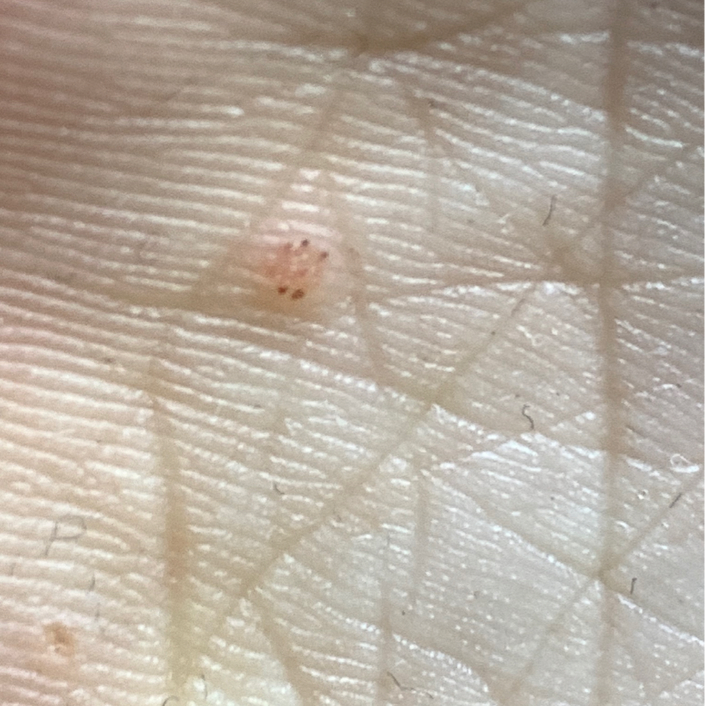 Локальная обработка поверхностного гиперкератоза в зоне бородавки 1-2 шт