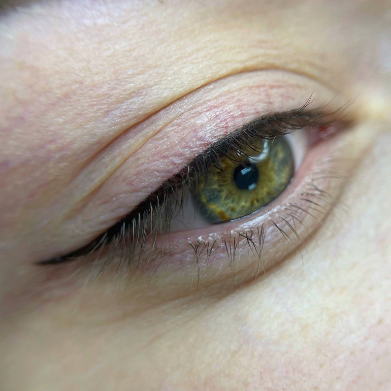 Коррекция стрелки через 1-2 месяца после первичной процедуры