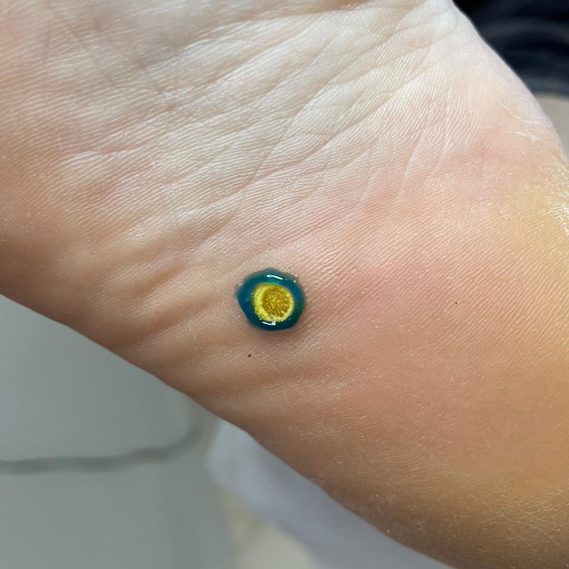 Удаление бородавок.