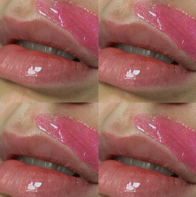 Депиляция верхней губы