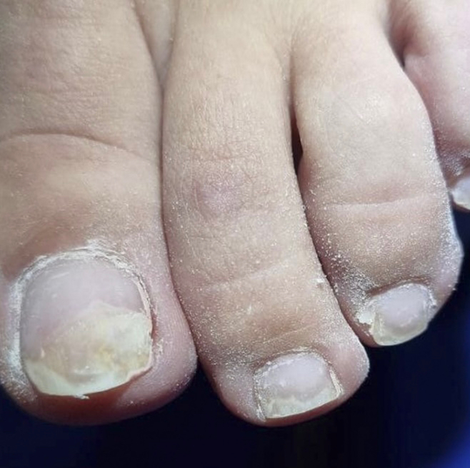 Зачистка онихолизиса  1 ноготь на ногах+ санация ногтевого ложа