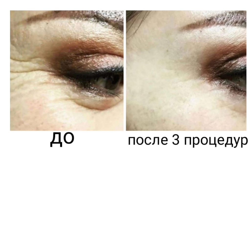 Мимические морщины (гусиные лапки)