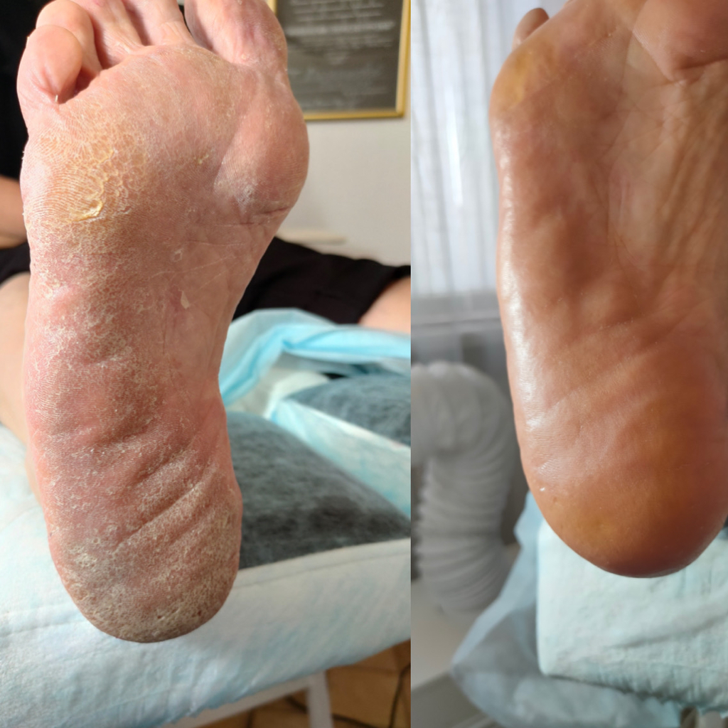 Сложный комплексный педикюр для стопы с отклонениями от нормы