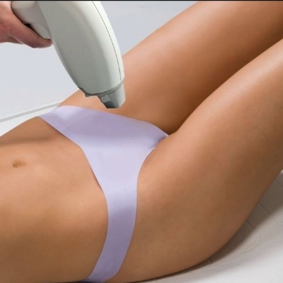 Лазер глубокое бикини