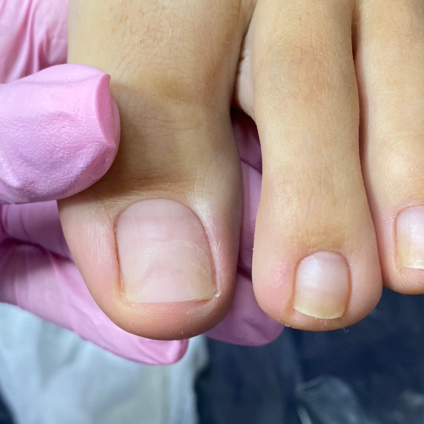 Протезирование ногтя