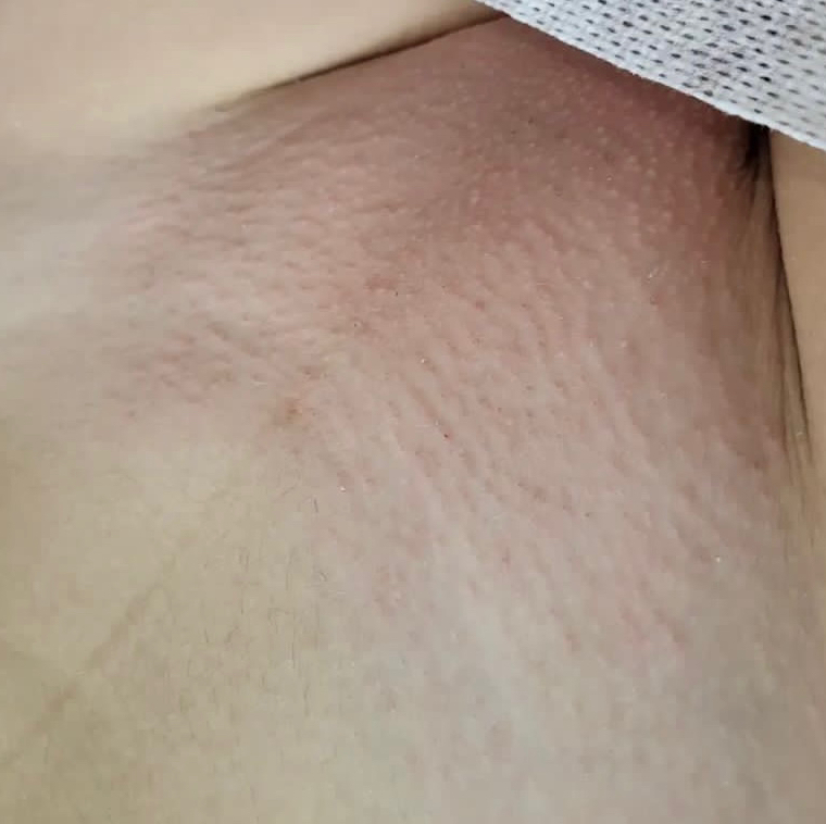 Восковая депиляция Глубокое бикини