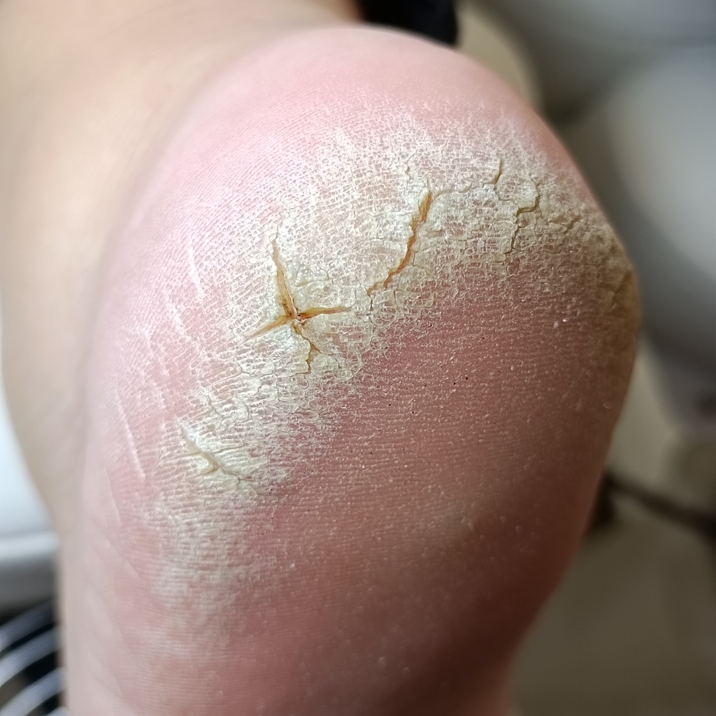 Педикюр сложная стопа кератоз/гиперкератоз/гипергидроз