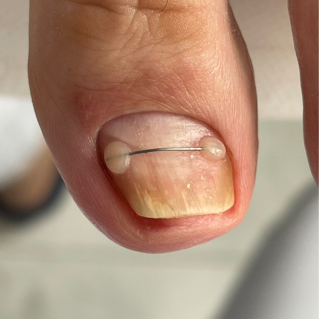 Коррекционная система «Титановая нить»(1 ноготь)