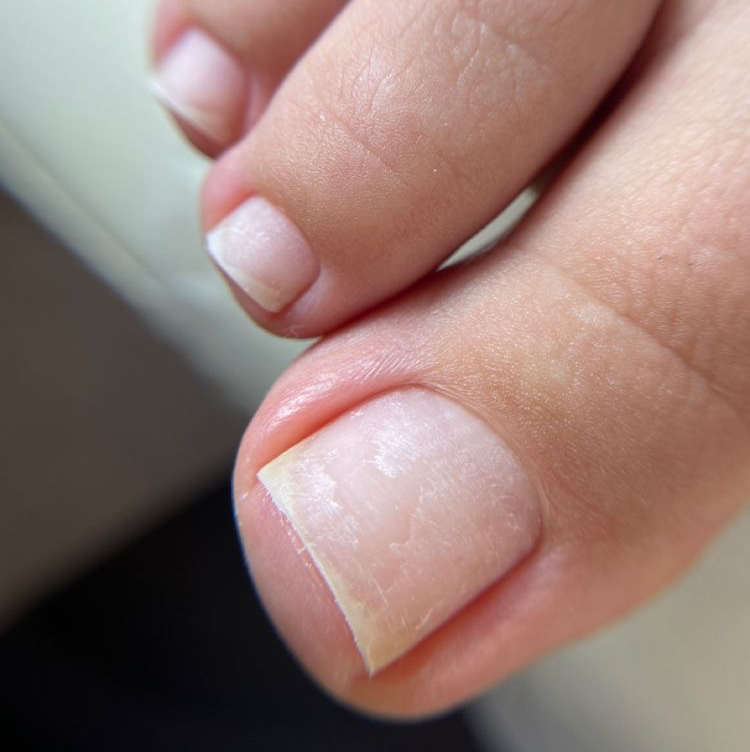 Апаратный педикюр