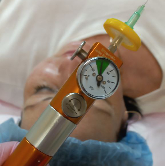 Карбокситерапия