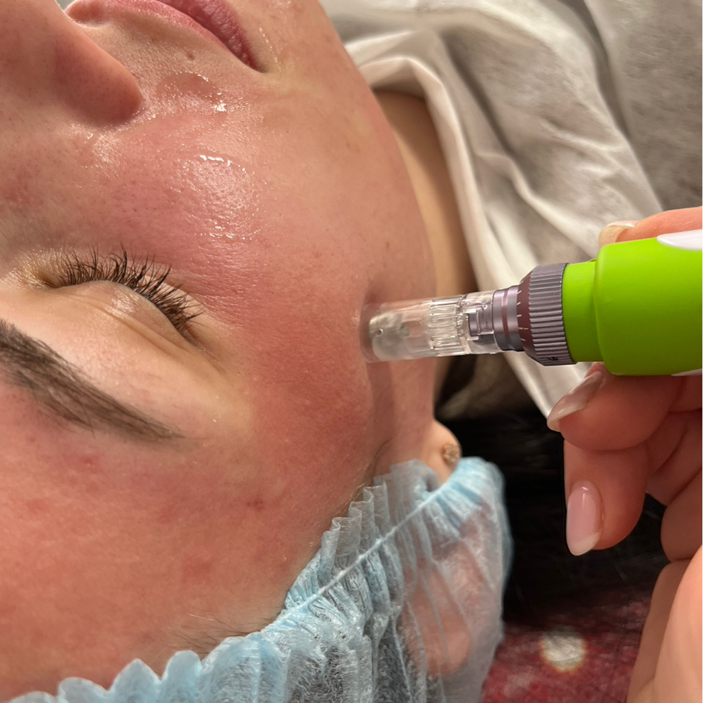 Фракционная мезотерапия