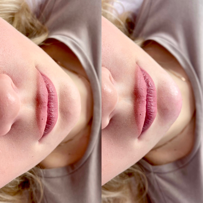 Коррекция подбородка