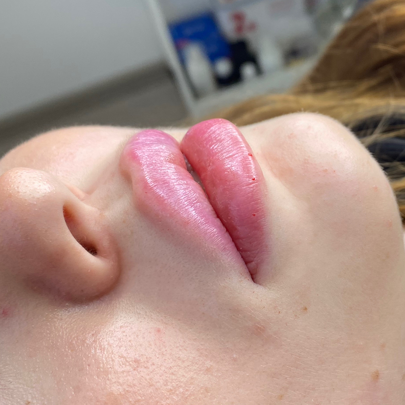 Увеличение губ,препарат Корея(Tesoro/Medeyra)