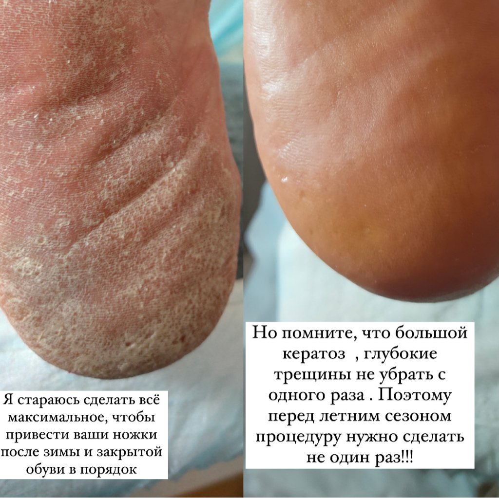 Педикюр Эстетика ( обработка ступни +пальцев без отклонений , без покрытия )