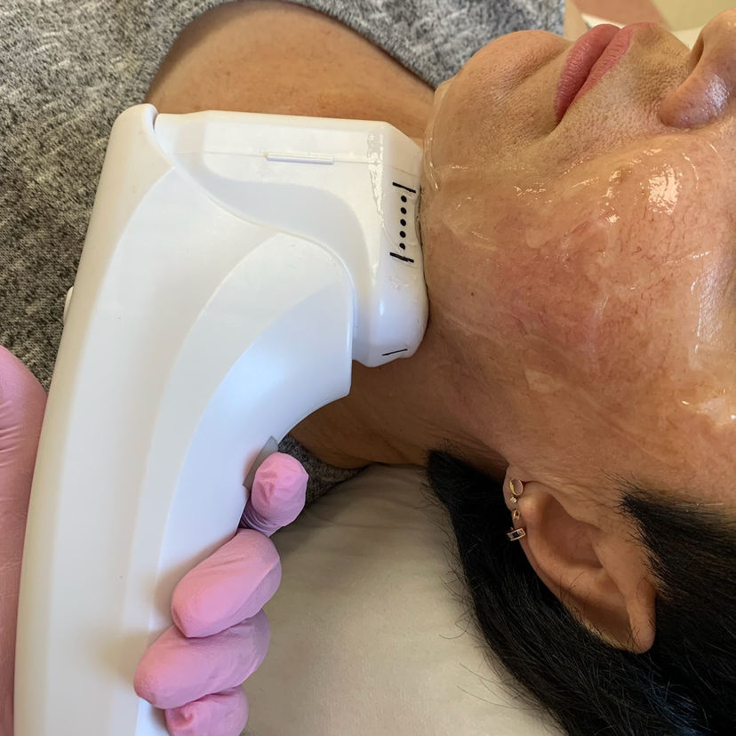 Smas лифтинг (Нижняя треть: брыли, подбородок)