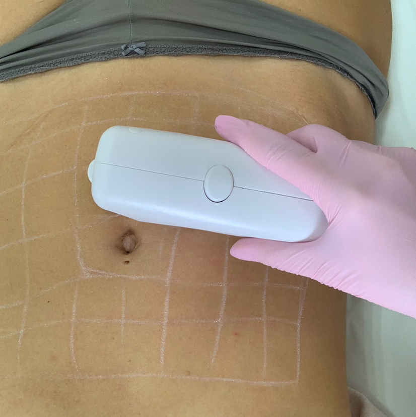 Smas лифтинг (Живот+бока)